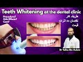 Teeth whitening treatment at dentist by dr talha bin aslam