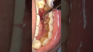 scaling karang gigi dokter gigi ruliyanto #short #scaling #dentist #tartar