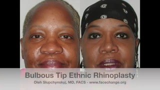 Ethnic Bulbous Tip Rhinoplasty