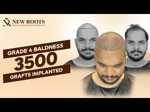 New Hairline Loading… 3500 Grafts Implanted 🤯 | Hair Transplant in Pune | New Roots