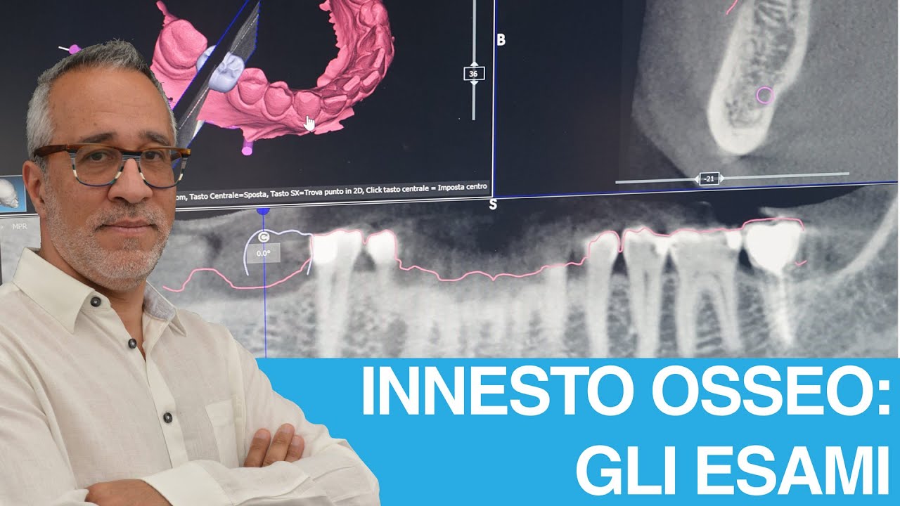 Innesto osseo per impianto dentale: quali esami servono?