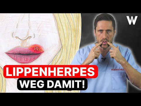 Video: So erkennen Sie, ob Sie eine Lippenherpes haben (mit Bildern)