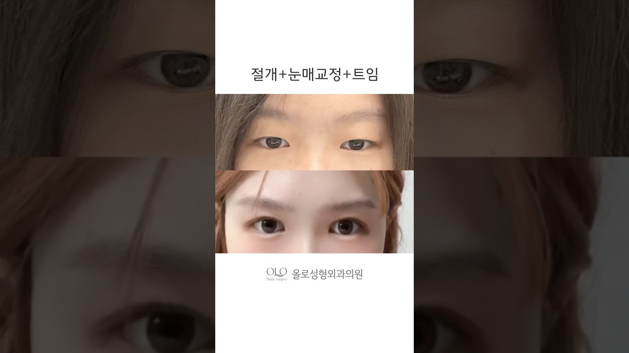 [ОЛО гоо сайхны мэс заслын эмнэлэг] Ганцхан нүдний мэс заслаар айдолтой адилхан болох уу?.. #НүднийМэсЗасал #НүднийМэсЗасалСайнХийдэгЭмнэлэг