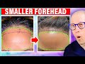 How To Fix a Large Forehead (Forehead Reduction)