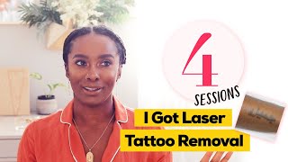 Amazing Laser Tattoo Removal Results!
