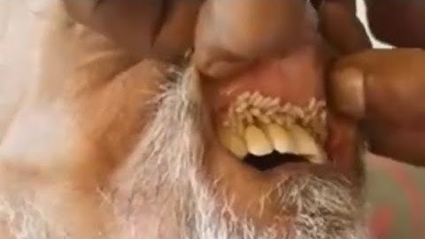 Oral maggots | worms inside the mouth | oral myiasis shocking video of old man 🙀