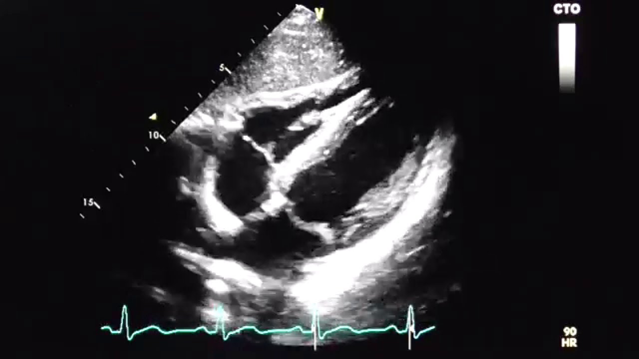 Subkostaler 4-Kammerblick (subcostal 4 - chamber view) - YouTube