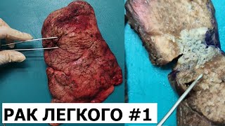 Периферический рак легкого #1 - гистологическое исследование (вырезка)