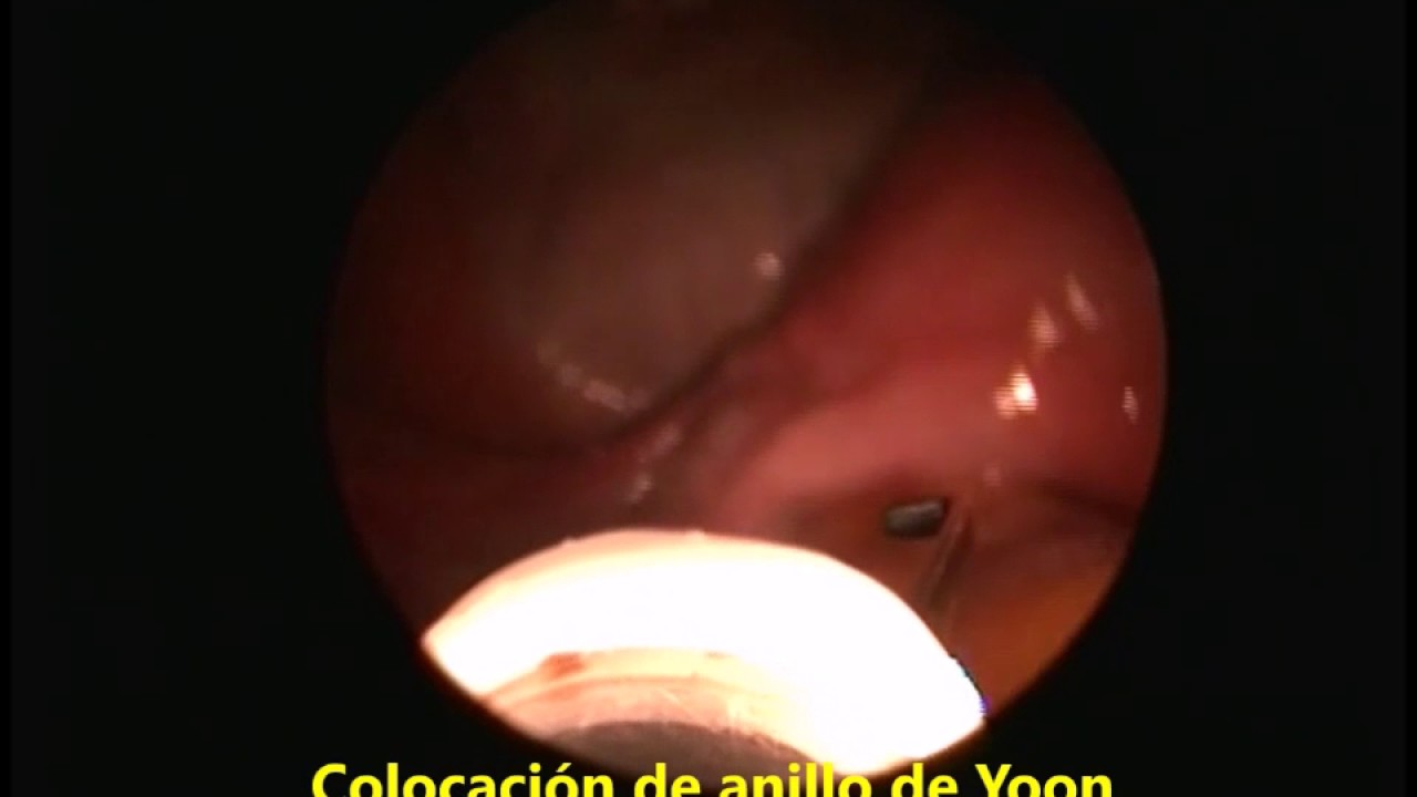 ESTERILIZACION TUBARICA BILATERAL CON ANILLOS DE YOON - YouTube