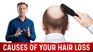 The Underlying Root Cause Of Hair Loss – Treatment For Hair Loss Dr. Berg