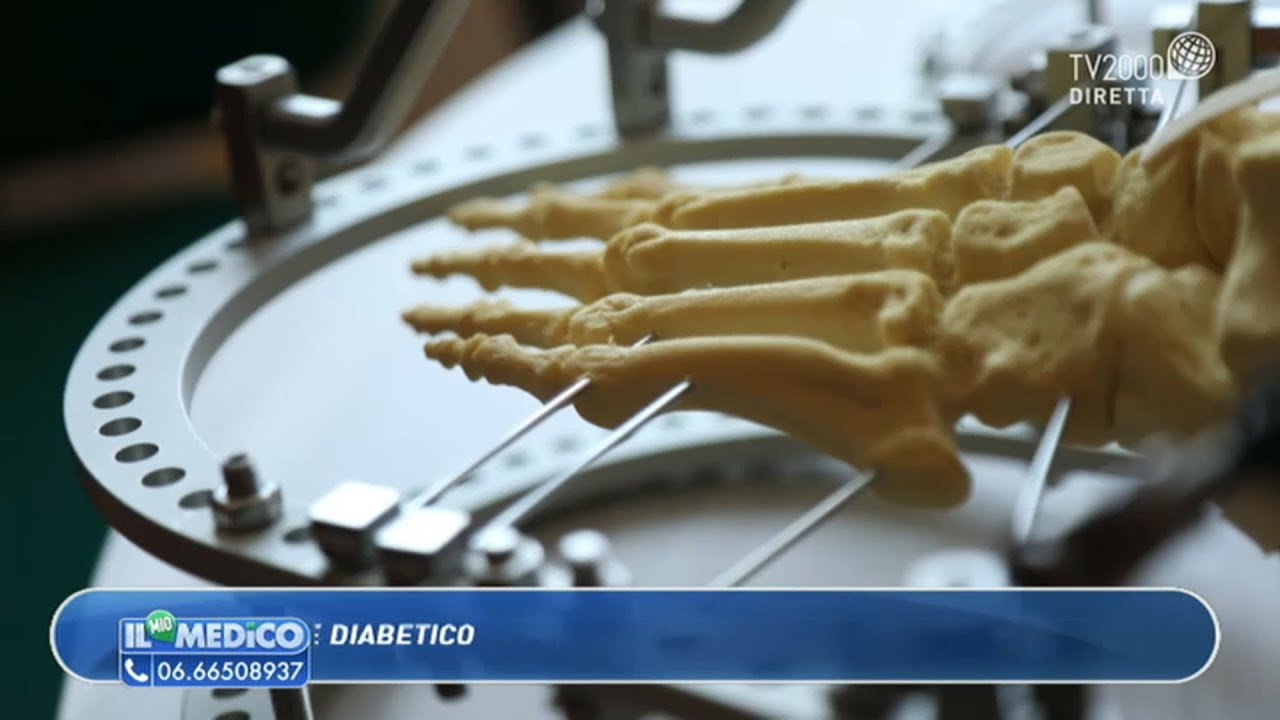 Il Mio Medico - Piede diabetico: cosa fare?