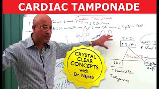 Cardiac Tamponade | Causes Symptoms and Treatment🫀