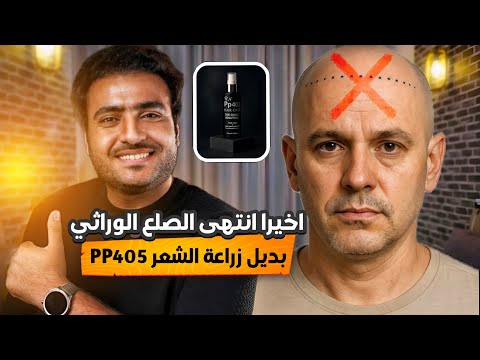 ال 405 أقوى علاج للصلع الوراثي هل هيكون فعال فعلا و يكون بديل لزراعة الشعر برنامج البسيط