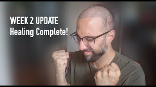 Hair Transplant in Turkey - Week 2 Update / Healing Completed! My thoughts so far! #hairtransplant