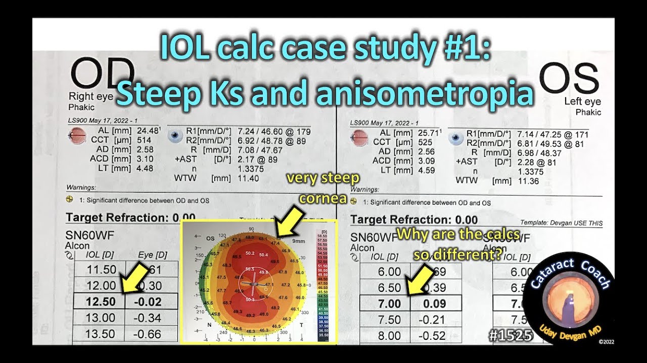 CataractCoach 1525: IOL calc case study #1: steep Ks and anisometropia