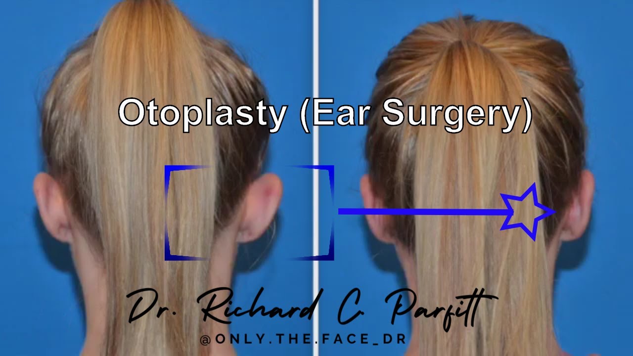 Why Otoplasty? (Ear surgery before and after) YouTube