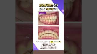 가만히 있어도 자꾸만 벌어지는 입...? #shorts