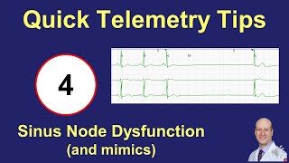 Telemetry Tips  Sinus Node Dysfunction