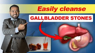 Safe and Effective way to remove gallbladder stone | best and non-invasive | Dr Haque