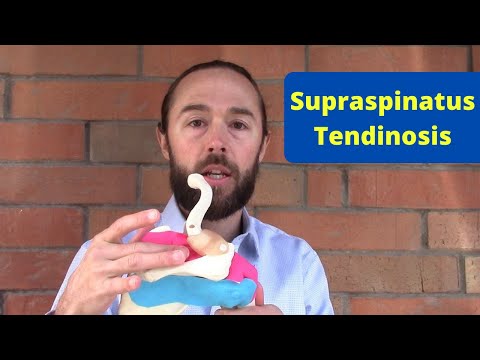 Video: Puas supraspinatus tendinosis yuav tsum tau phais?