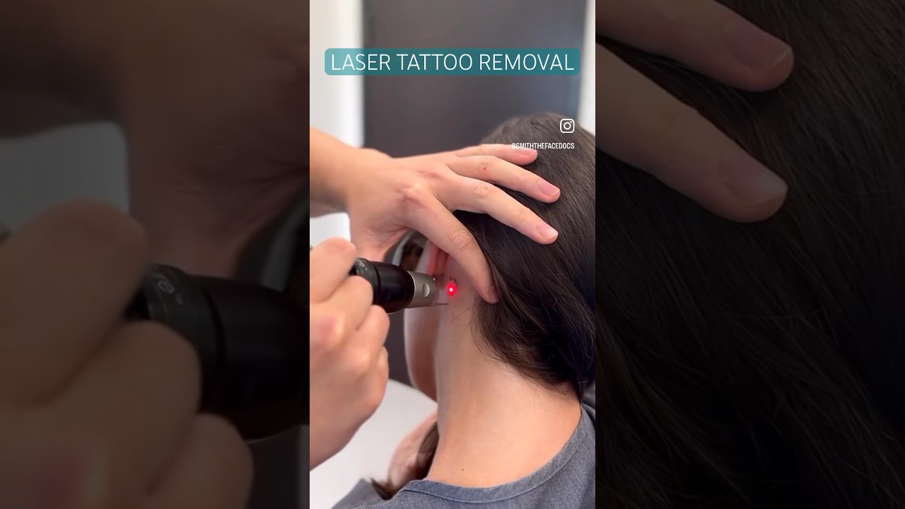 Laser tattoo removal with the PicoSure laser. 