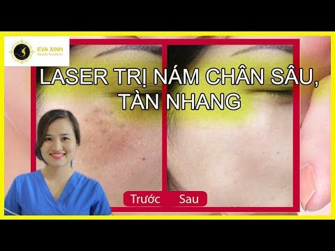 Laser điều trị nám chân sâu,tàn nhang hiệu quả | Laser treatment deep burns, freckles effectively