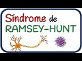 Síndrome de Ramsey Hunt