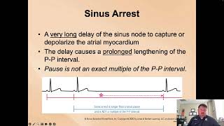 Paramedic Cardiology Module 3-1 Lecture 5: Sinus Pause Block and Arrest