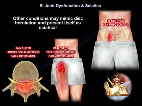 Sciatic Pain Associated with Lumbar Disc Conditions