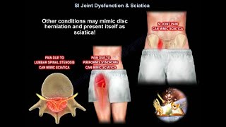 SI Joint Dysfunction & Sciatica , which one is  causing the pain , how do we treat it
