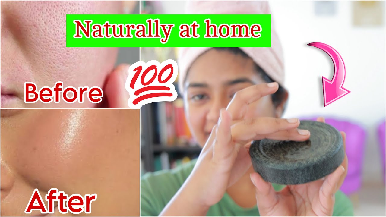 മുഖത്തെ കുഴികൾ മാറ്റാം എളുപ്പത്തിൽ_how to remove pores easily at home_simply my style Unni