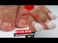 Ex Nail Biter Transformation Finale | 2 Corrections In 1 | Couldn't Believe My Eyes!