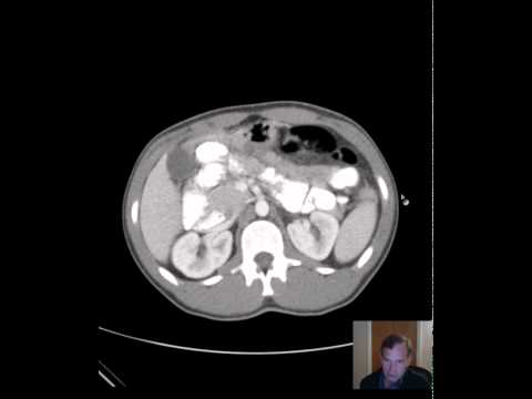 CT Distal Small Bowel Obstruction