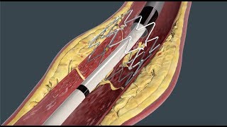 Tack Endovascular System® mechanism of action (MOA)