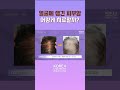 피부암도 약으로 치료할 수 있을까?
