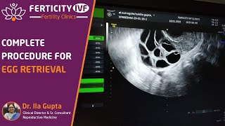 Complete procedure for egg retrieval