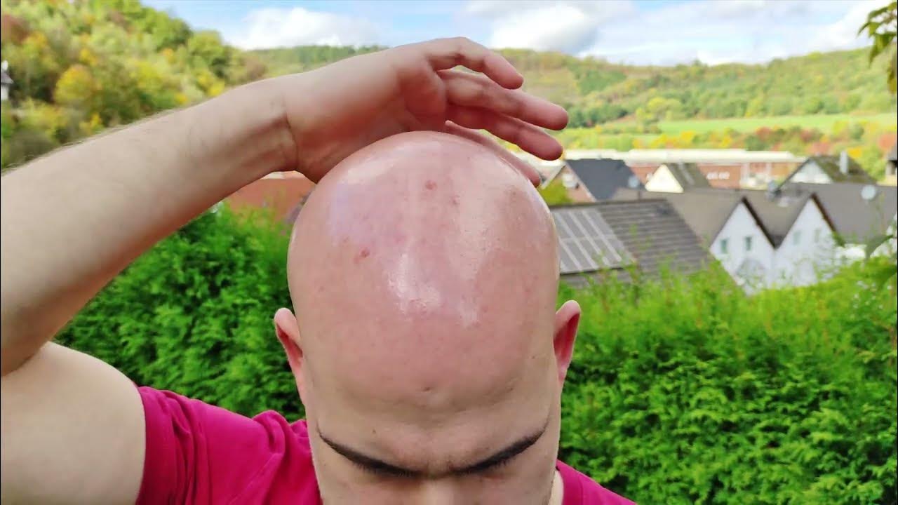 the-extreme-shine-of-my-lasered-bald-head-8-days-no-shave-16-10