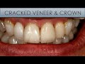 Replacing a Cracked Veneer & Crown