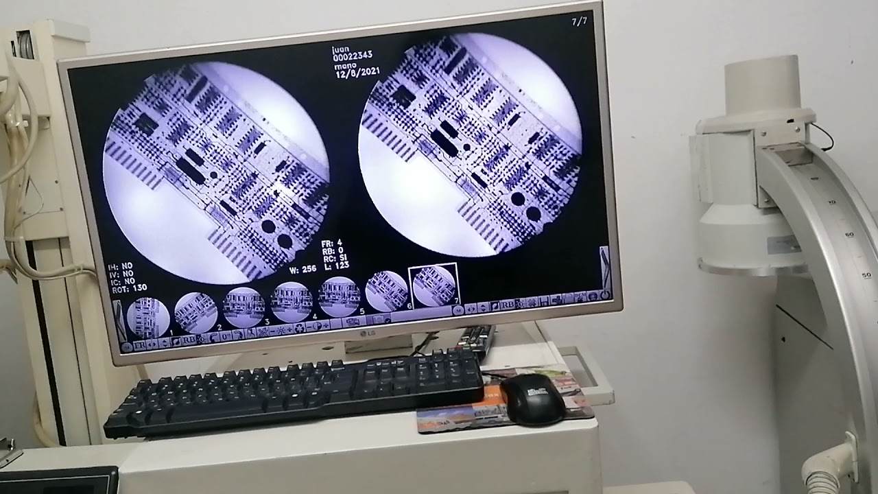 Arco en C Philips BV25 Digitalizado