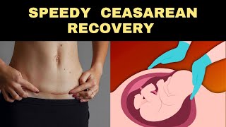 Speed Up Your C-Section (Caesarean) Recovery with These Health Tips