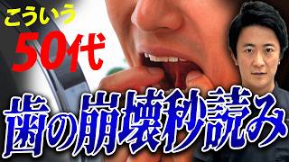 歯科医が警告】1本の欠損が命取り！歯抜け連鎖で口腔内崩壊します