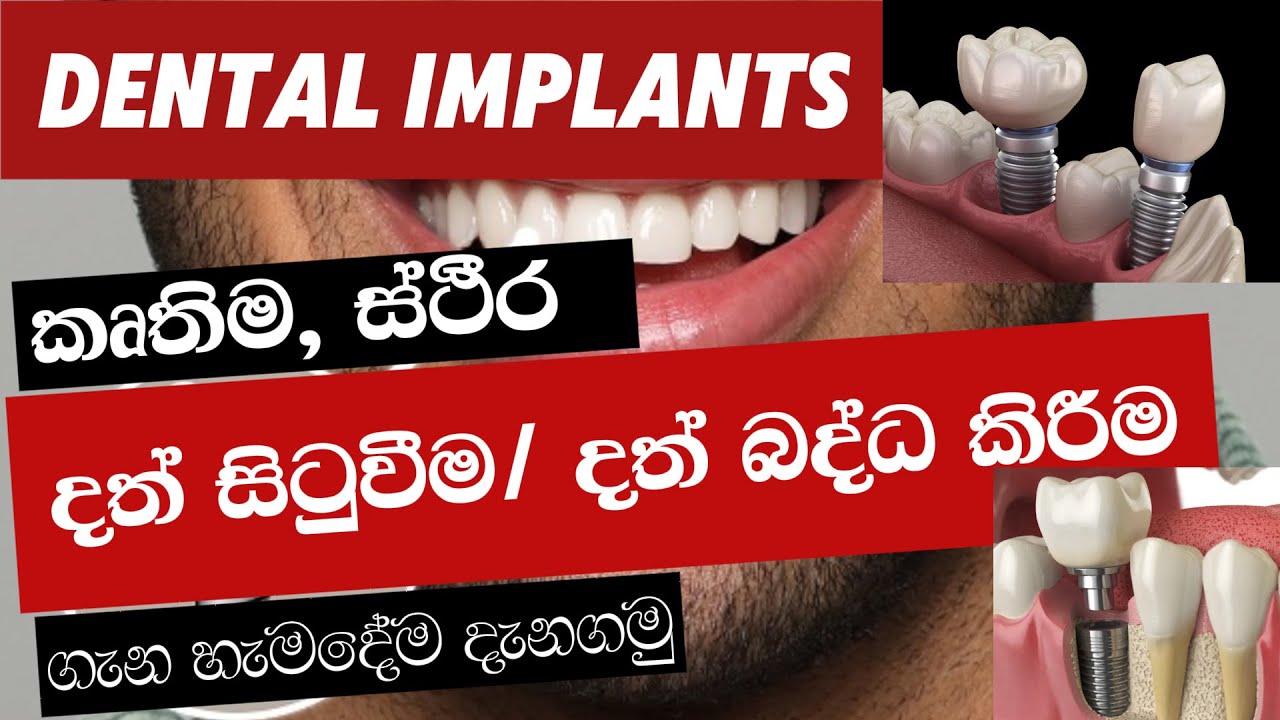කෘතීම දත් සිටුවීම | ස්ථීර දත් බද්ධ කිරීම | Dental Implants