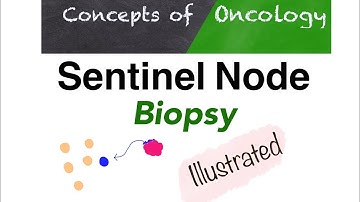 Sentinel node biopsy - A simple way to Understand