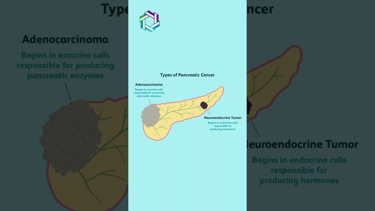Types Of Pancreatic Cancer Explained Knowing The Different Forms Dr Vivek Sukumar