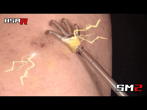 【かゆかゆアトピー性皮膚炎ASMR】超痒い大腿部をステンレス爪で掻く音/癒し/リラックス効果/睡眠導入/マッサージ