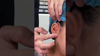 Ear prosthesis adhesive retention type