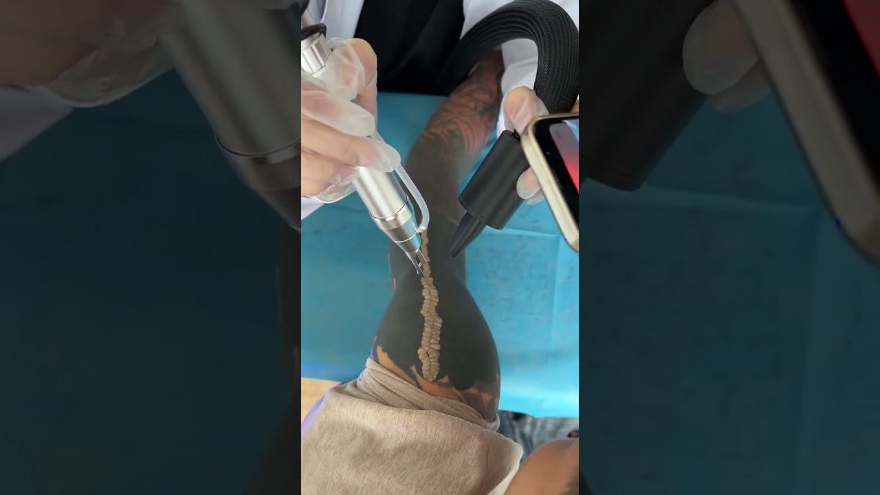 SCAR FREE TATTOO REMOVAL ep16 