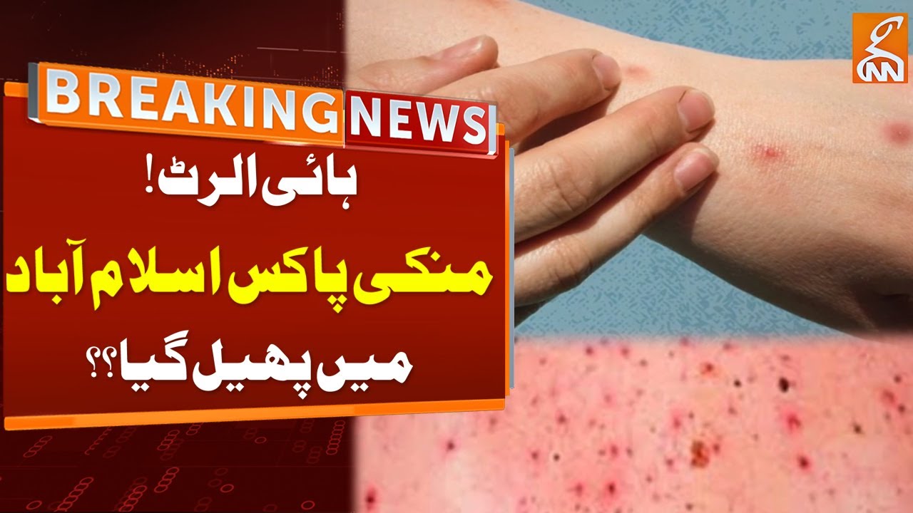 Monkeypox Cases Detected In Islamabad | Breaking News | GNN - YouTube