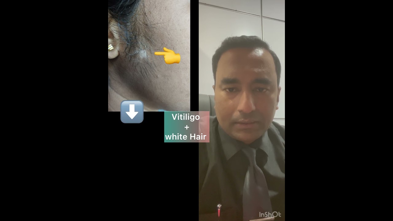 👨‍⚕️✅#විටිලිගෝ##Vitiligo සමග අසල හිසකෙස්  සුදු වීම, .#drmilindaabeykoon##aanyahealt.👉0776965999,