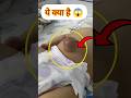 Umbilical Hernia #shorts #youtubeshorts #nurse#nursing #healthtips #medical#hernia #nursingeducation
